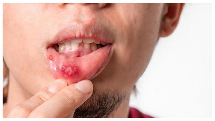 মুখে ঘা হয়েছে, কিছু খেতে পারছেন না? রইল ৫টি অব্যর্থ প্রতিকার!