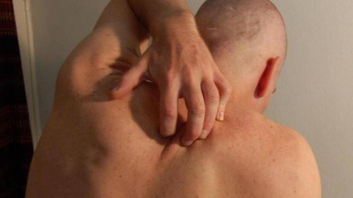 জানুন ঘামাচি থেকে মুক্তি পাওয়ার উপায়