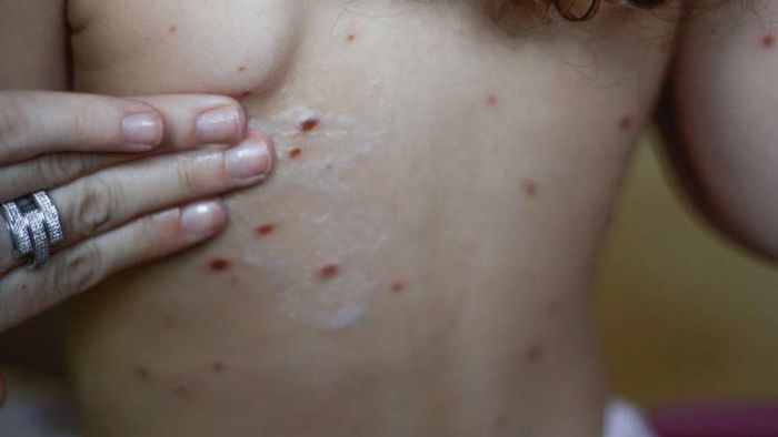 পক্সের চিহ্ন