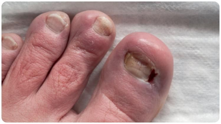 বর্ষায় নখকুনি হয়েছে? রইল ৫ অব্যর্থ উপায়