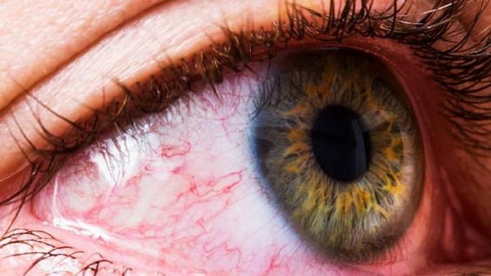 চোখ লাল, গুরুত্ব দিন