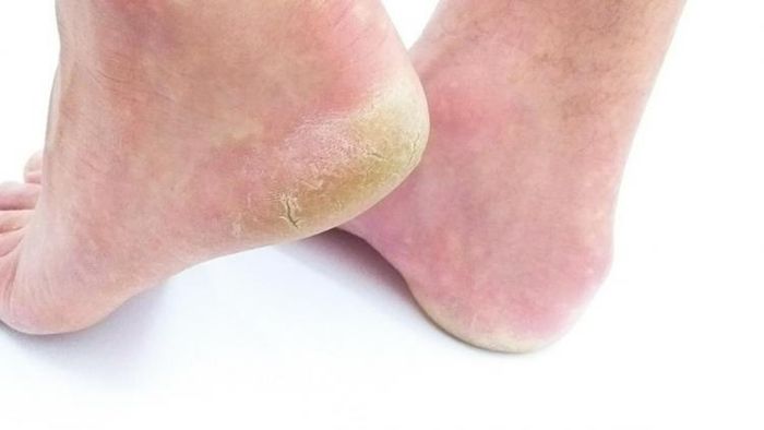 পা ফাটার সমস্যা থেকে মুক্তির উপায়।