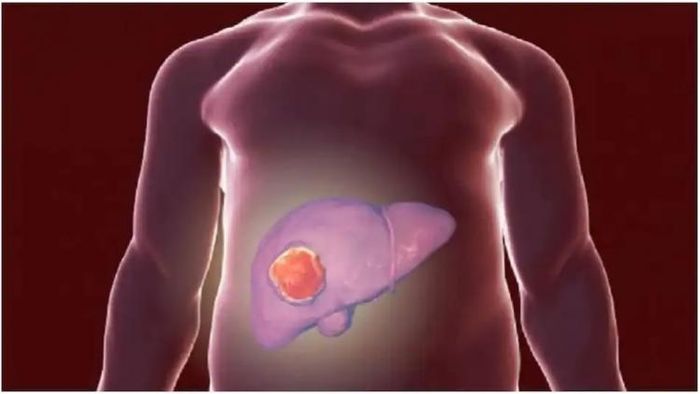 ফ্য়াটি লিভার সম্পর্কে সচেতন হন (প্রতীকী ছবি)