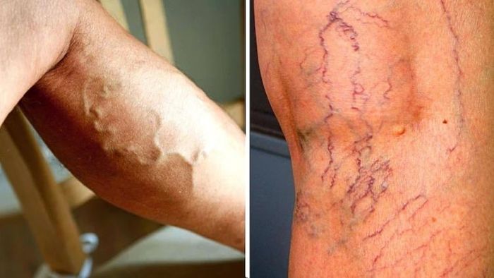 পায়ে নীল শিরা দেখা দিলে অবহেলা নয় (প্রতীকী ছবি)