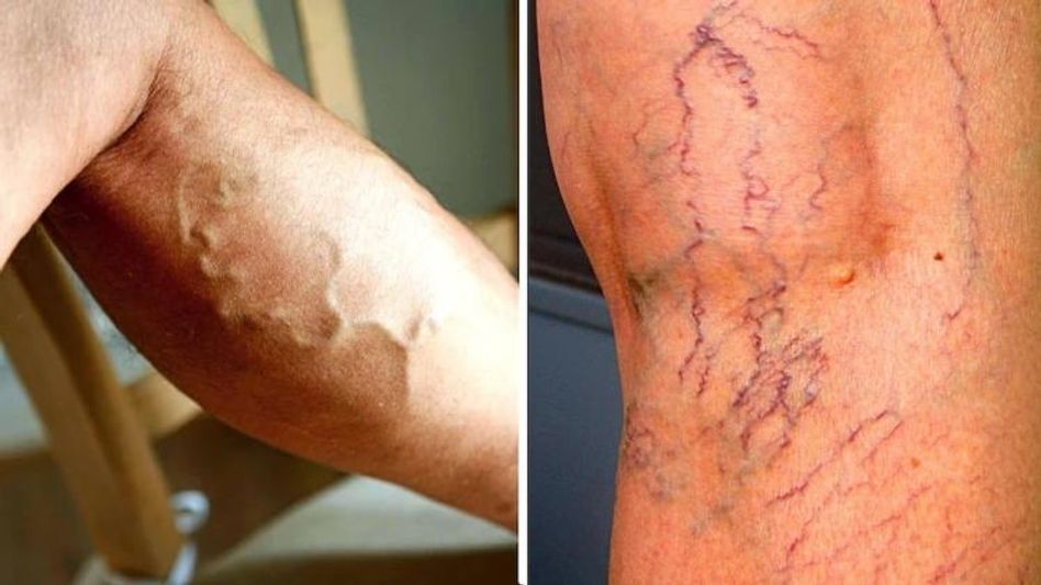 পায়ে ফুটে উঠছে নীল শিরা, খুব সাবধান! গুরুতর সমস্যার লক্ষণ পায়ে ফুটে উঠছে নীল শিরা, খুব সাবধান! গুরুতর সমস্যার লক্ষণ