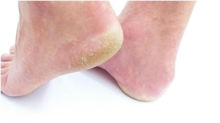 বছরভর পা- ঠোঁট ফাটার সমস্যায় ভুগছেন, ভিটামিনের ঘাটতি নয়তো?