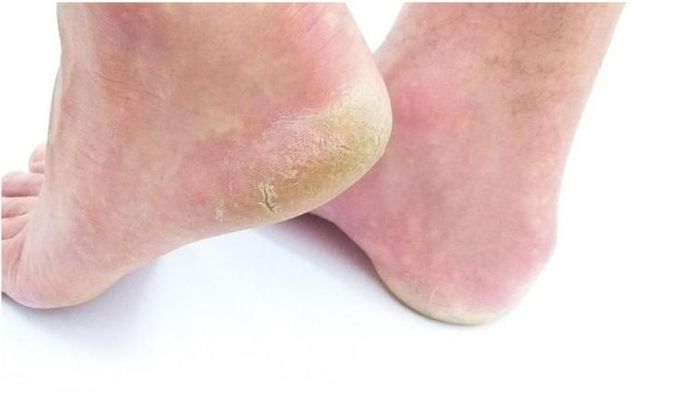 পা ফাটা/ প্রতীকী ছবি