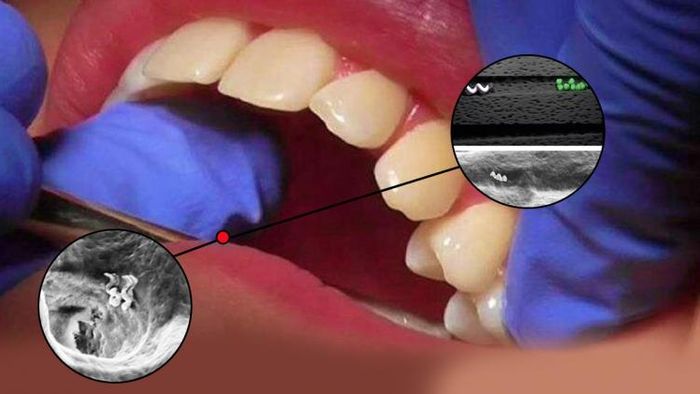 দাঁতের চিকিৎসায় ন্যানো রোবট (প্রতীকী ছবি)