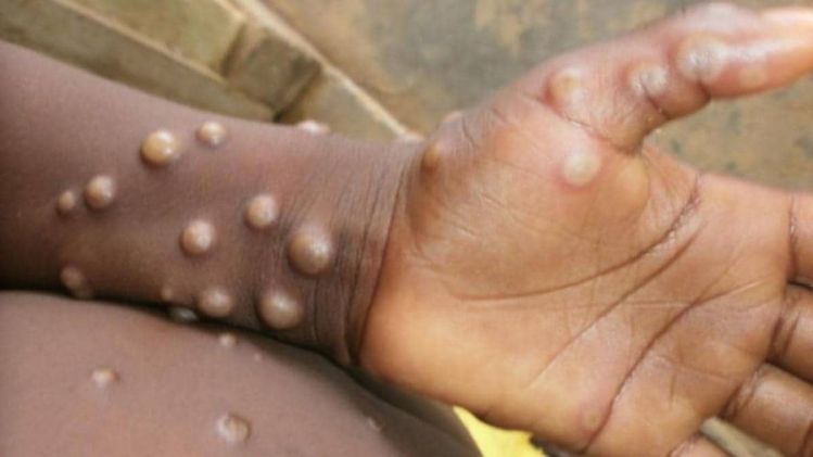 ৯ দেশে Monkeypox আতঙ্ক, জরুরি বৈঠকে WHO, সতর্কতা ভারতেও