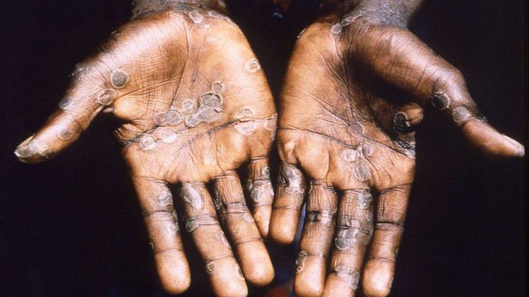 COVID-এর মতোই অতিমারি হবে Monkeypox?