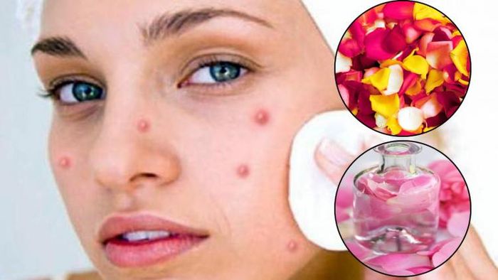 ব্রণ থেকে মুক্তি পেতে জাদুকরী গোলাপ জল