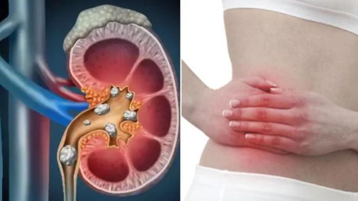 কিডনির পাথরের প্রতিকার।
