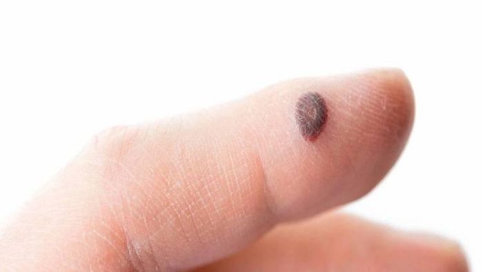 আঁচিলের সমস্যা। প্রতীকী ছবি