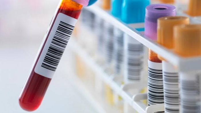 প্রাক-ম্যালিগন্যান্ট হেমাটোলজিক অবস্থার সনাক্তকরণ কমাতে পরীক্ষার আগের সংস্করণটি পরিমার্জিত হয়েছিল। (ছবি: গেটি)