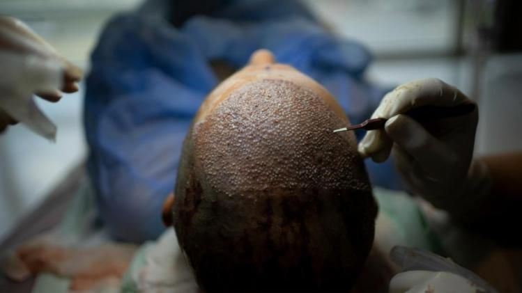 হেয়ার ট্রান্সপ্লান্ট করে মৃত্যু! এই সব ভুলেই প্রাণ গেল ৩০-র ব্যক্তির