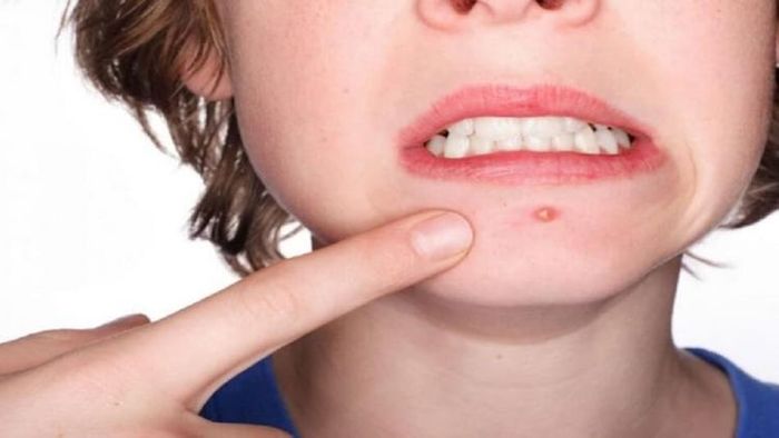 মুখে এমন গোটা উঠেছে? সাবধান এটা কিন্তু ব্রণ নয়