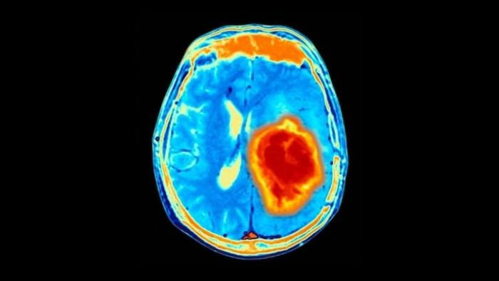 রাতে মাঝে মধ্যেই দুঃস্বপ্ন দেখেন? সাবধান, ডিমেনশিয়ার পূর্বাভাস হতে পারে