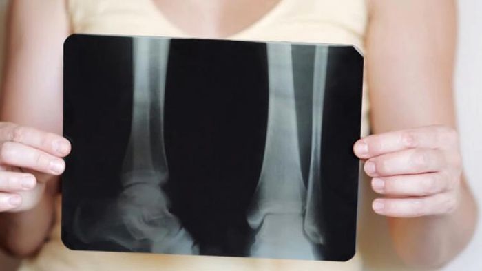 হাড় ক্ষয়ের কারণ।