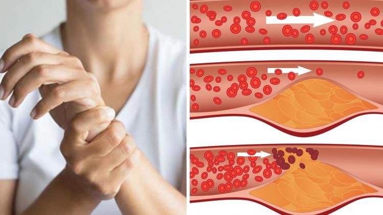 কোলেস্টেরলের উপসর্গ।