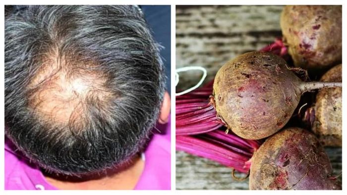 টাকের জন্য বিশেষ হেয়ার প্যাক