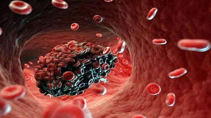 শিরা -ধমনীতে রক্ত জমাট বাঁধা বিপজ্জনক