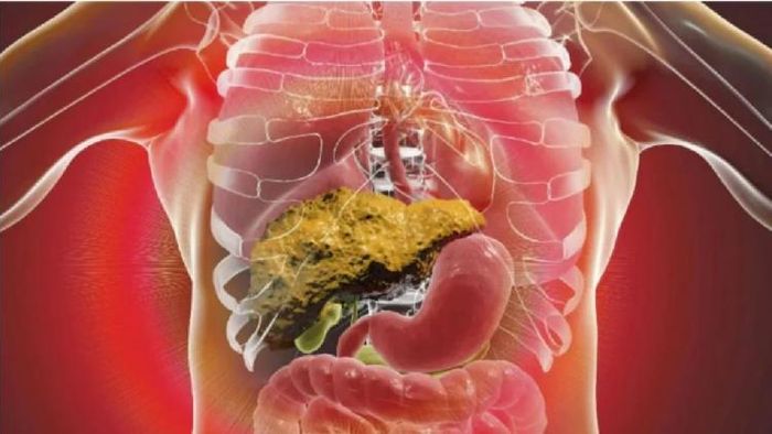 ফ্যাটি লিভার