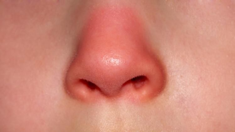 ঠান্ডায় নাক লাল হয়ে যায়? আপনি বড় বিপদের মুখে দাঁড়িয়ে নেই তো