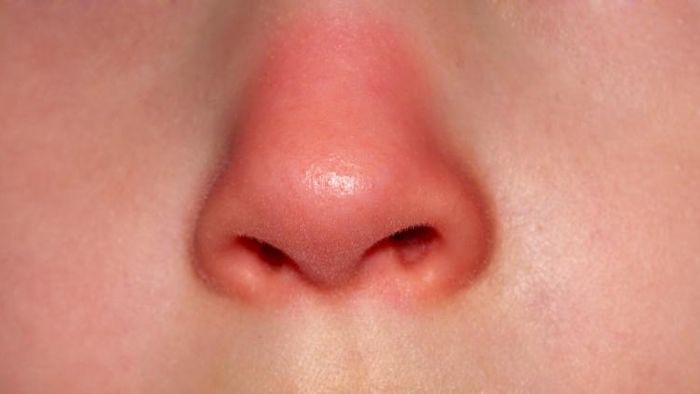 ঠান্ডায় নাক লাল হয়ে যায়? আপনি বড় বিপদের মুখে দাঁড়িয়ে নেই তো