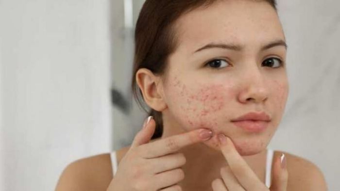 ঘুমের ৫ ভুল যা ব্রণকে ট্রিগার করে