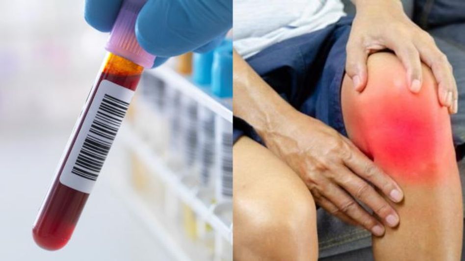 রক্তে কতটা ইউরিক অ্যাসিড স্বাস্থ্যের জন্য ভাল, কখন ডেকে আনে বিপদ? জানুন রক্তে কতটা ইউরিক অ্যাসিড স্বাস্থ্যের জন্য ভাল, কখন ডেকে আনে বিপদ? জানুন