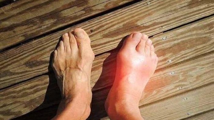 ইউরিক অ্যাসিড থাকলে এই ডাল বিষের সমান, একদম ছোঁবেন না