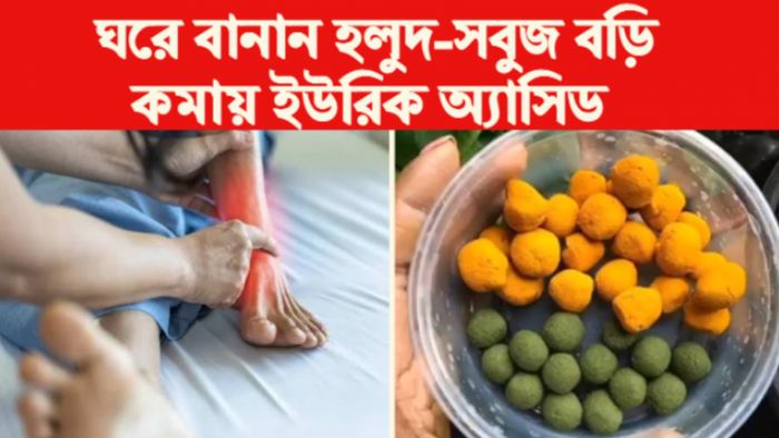 uric Acid Home Remedies ইউরিক অ্যাসিডের ঘরোয়া প্রতিকার।