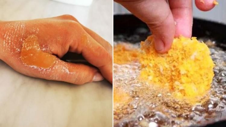 পড়বে না ফোস্কা এই ঘরোয়া নিয়ম মানলে