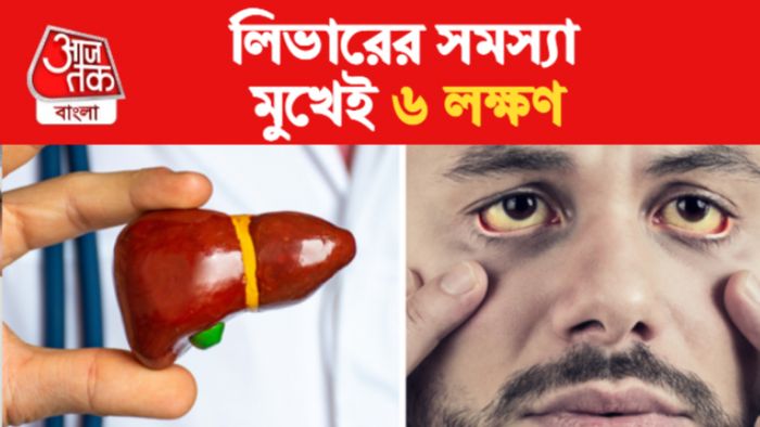 ফ্যাটি লিভারের লক্ষণ।