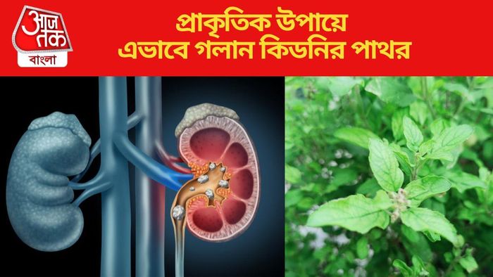 প্রাকৃতিক উপায়ে এভাবে গলান কিডনির পাথর