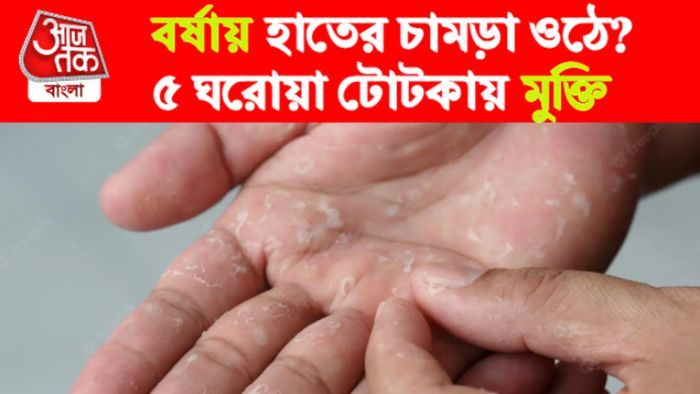 ত্বকের চামড়া ওঠে কেন?