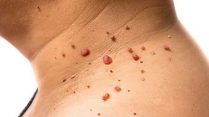 আঁচিল, প্রতীকী ছবি