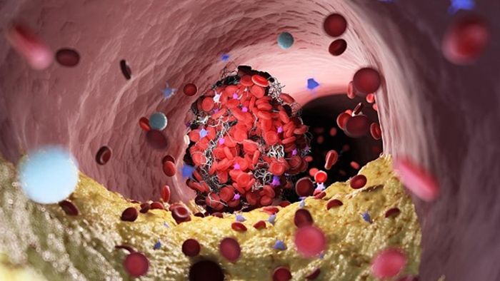 চ্চ কোলেস্টেরল নীরব ঘাতক