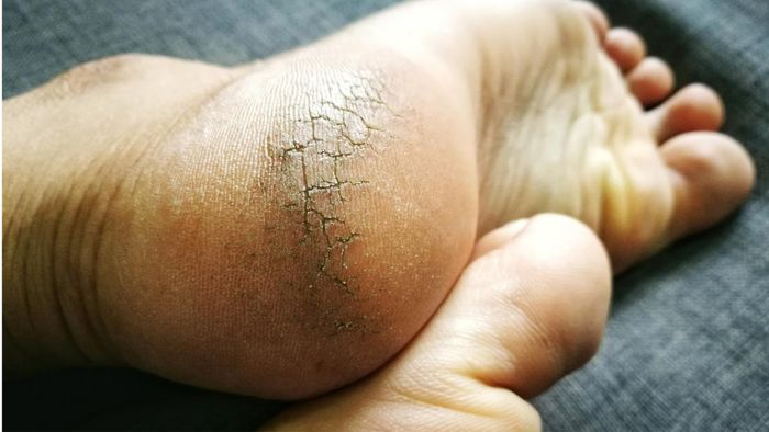 ফাটা গোড়ালির জন্য লজ্জিত? এই ৭ সহজ ঘরোয়া উপায়ে ফিরে পান পায়ের সৌন্দর্য!