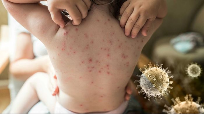 বসন্তে হতে পারে চিকেন পক্স, সতর্ক থাকতে করুন এই কাজ