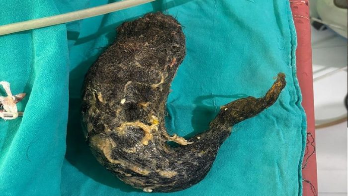 ৩১ বছরের এক তরুণীর পেট থেকে ২ কেজি চুলের গোছা বের করলে ডাক্তাররা