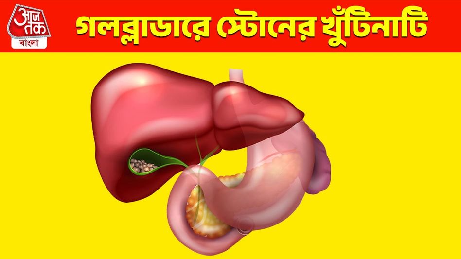 কীভাবে বুঝবেন আপনার গলব্লাডারে স্টোন হয়েছে? জানুন পেটে পাথরের চিকিৎসা কী কীভাবে বুঝবেন আপনার গলব্লাডারে স্টোন হয়েছে? জানুন পেটে পাথরের চিকিৎসা কী