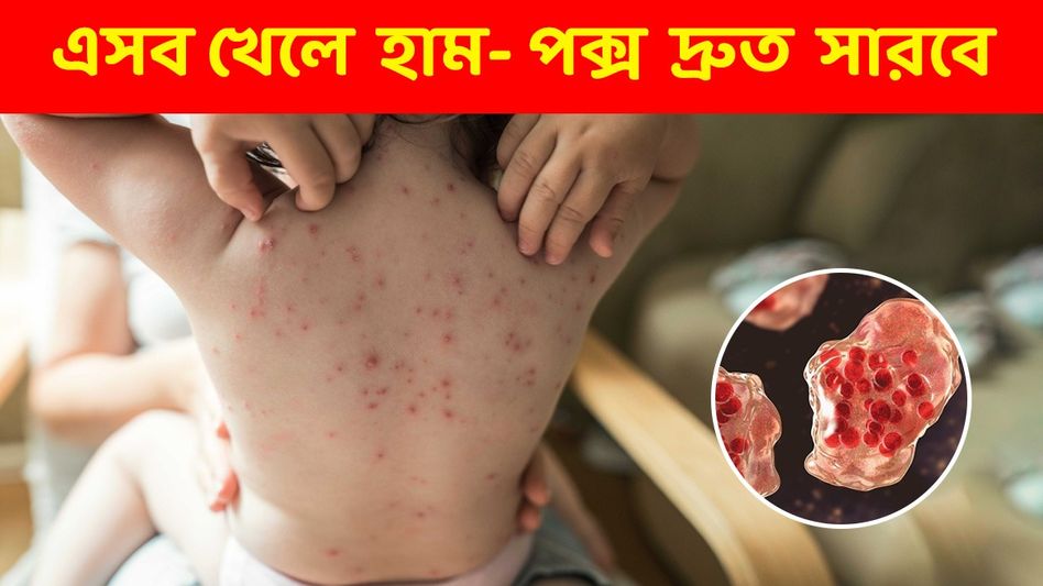 ঘরে ঘরে দেখা দিচ্ছে হাম- পক্স! জানুন দ্রুত নিরাময়ে কী খাবেন- কী খাবেন না? ঘরে ঘরে দেখা দিচ্ছে হাম- পক্স! জানুন দ্রুত নিরাময়ে কী খাবেন- কী খাবেন না?