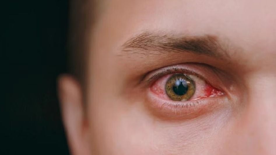 চোখ দেখেই বোঝা যাবে স্ট্রোকের লক্ষণ