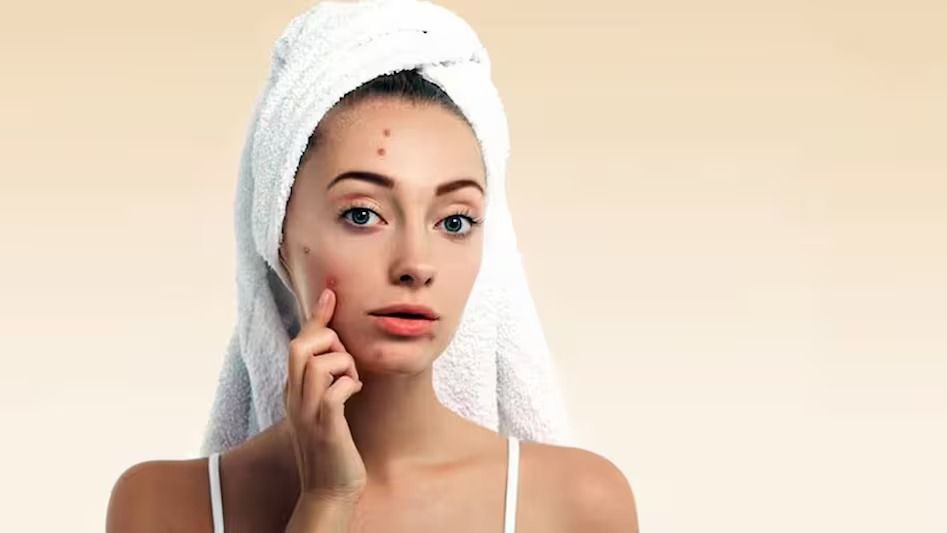 হরমোনজনিত ব্রণ থেকে রেহাই পাওয়ার সহজ সমাধান, শুধু খান এসব খাবার 