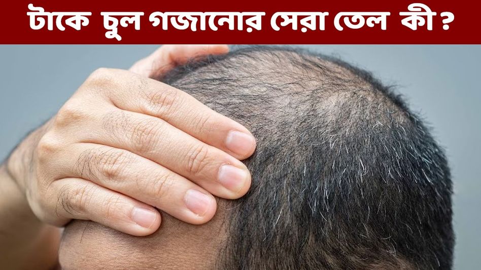 এই বিশেষ তেল এভাবে লাগালেই গড়ের মাঠের মতো মাথাতেও গজাবে চুল  এই বিশেষ তেল এভাবে লাগালেই গড়ের মাঠের মতো মাথাতেও গজাবে চুল