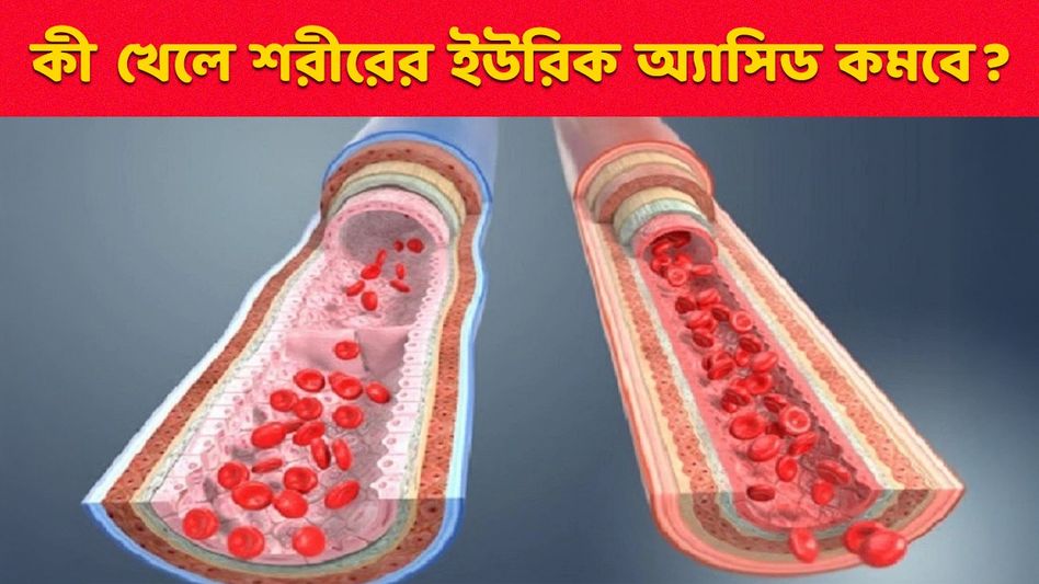 হু হু করে কমবে ইউরিক অ্যাসিডের মাত্রা, খান এসব হলুদ খাবার হু হু করে কমবে ইউরিক অ্যাসিডের মাত্রা, খান এসব হলুদ খাবার