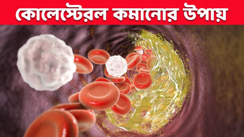 ওষুধ ছাড়াই কোলেস্টেরলের মাত্রা কমাতে চান? ঘরে বসেই করুন এই ৫ কাজ ওষুধ ছাড়াই কোলেস্টেরলের মাত্রা কমাতে চান? ঘরে বসেই করুন এই ৫ কাজ