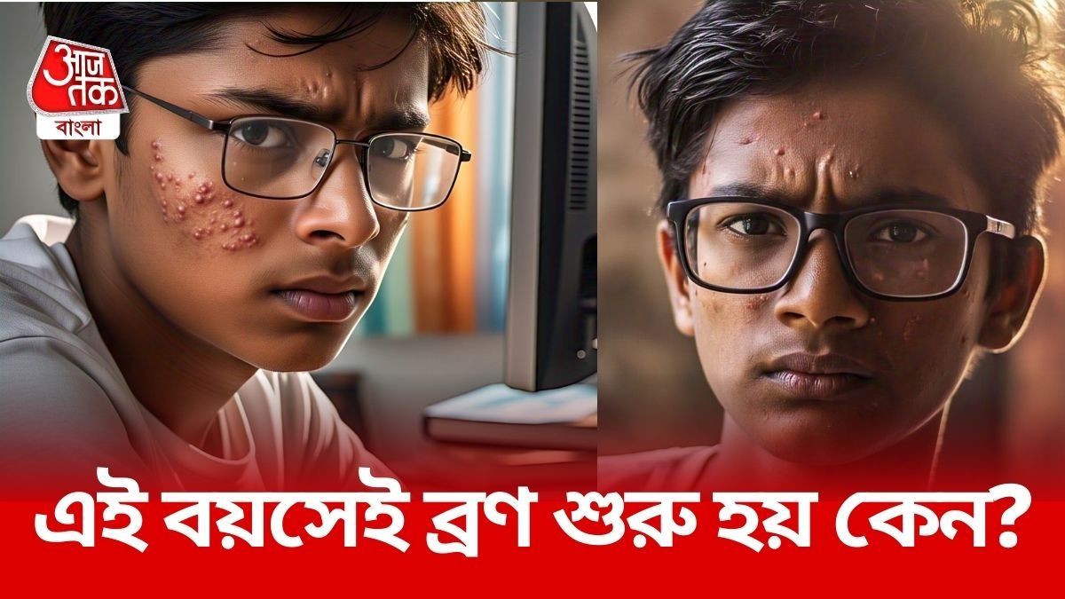 কিশোর বয়সে এত ব্রণ হয় কেন? এতদিনে কারণটা জানলেন বিজ্ঞানীরা কিশোর বয়সে এত ব্রণ হয় কেন? এতদিনে কারণটা জানলেন বিজ্ঞানীরা