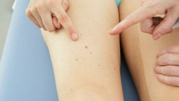 উরুতে তিল থাকা কীসের ইঙ্গিত, এসব মানুষদের স্বভাব-চরিত্র কেমন হয়? জেনে নিন